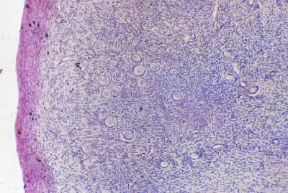 Involuzione . Ovaio senile con assenza di follicoli oofori e presenza dei cosiddetti corpi fibrosi albicali.De Agostini Picture Library