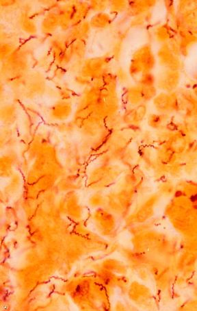 Il batterio della sifilide. Venereologia. Il Treponema pallidum è il batterio responsabile della sifilide, una tipica malattia a trasmissione sessuale. La sifilide congenita può essere trasmessa anche al feto per via transplacentare dopo la quinta settimana.