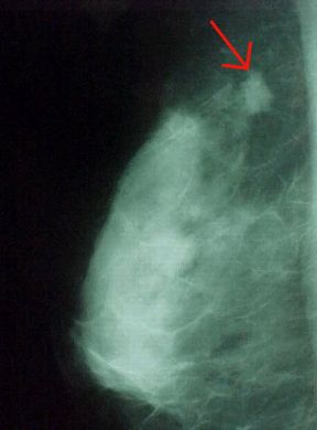 Rappresentazione di una mammografia. Diagnostica. L'esame radiologico diretto della mammella, o mammografia, è un importante strumento di radiodiagnostica. Consente infatti di visualizzare tutte le componenti anatomiche di questa struttura ghiandolare e di evidenziarne eventualmente le alterazioni patologiche. La freccia indica un nodulo mammario neoplastico.