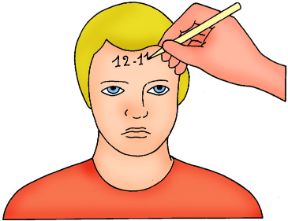 Annotazione dell'ora di applicazione del laccio emostatico. La compressione arteriosa. L’ora esatta di applicazione del laccio va sempre annotata.