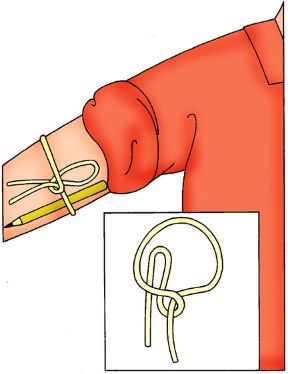 Uso corretto del laccio emostatico. Laccio emostatico. L'impiego del laccio emostatico dev'essere regolato da criteri ben precisi in quanto un uso inadeguato può esporre al rischio di gangrena.