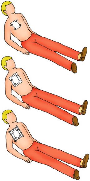 Intervento in caso di ferita al torace. Ferite al torace. Coprite la ferita con garza sterile fissata con cerotto.