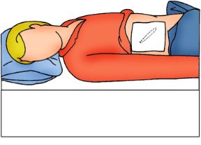 Intervento sulla ferita all'addome: coprite la ferita. Ferite all'addome. Coprite la ferita utilizzando un panno pulito.