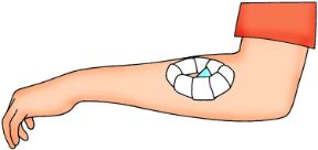 Intervento su ferita con corpo estraneo: applicazione del tampone. Ferite con corpo estraneo. Avrete così ottenuto un tampone ad anello da applicare sulla ferita senza toccare il corpo estraneo.
