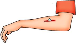 Intervento su ferita con corpo estraneo: non rimuovere il corpo estraneo. Ferite con corpo estraneo. Il corpo estraneo in una ferita non va estratto direttamente per evitare danni maggiori.