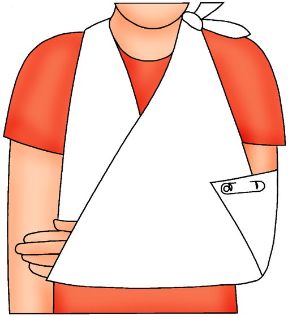 Necessità di immobilizzazione. Immobilizzazione. Le lussazioni e le fratture agli arti richiedono l'immobilizzazione prima del trasporto per evitare che lo spostamento dei frammenti causi la rottura di vasi, nervi, muscoli complicando la situazione.