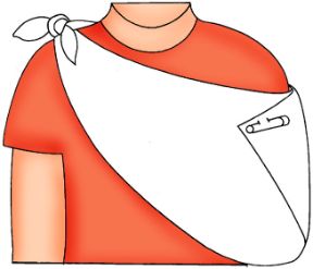 Frattura agli arti superiori. Caso di frattura della clavicola. Fratture agli arti. In caso di clavicola fratturata sorreggere il braccio corrispondente con una benda a fionda.