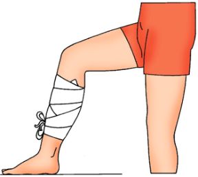 Intervento in caso di ustione da caustici. Bendaggio della parte lesa. Ustioni da custici. Proteggete la parte colpita con una garza sterile fissata con una benda.