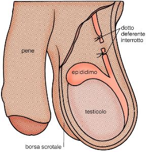 Resezione chirurgica del dotto deferente. Vasectomia. La resezione chirurgica del dotto deferente viene eseguita a scopo terapeutico, preventivo o anticoncezionale.