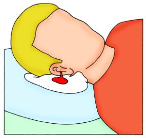 Intervento in caso di otorragia. Otorragia. Sdraiate l’infortunato sul lato offeso per permettere la fuoriuscita del liquido.