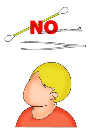 Corpo estraneo nell'orecchio: non usare strumenti inadatti. Corpi estranei nell'orecchio. Non tentate assolutamente di estrarre il corpo estraneo da soli o con l'aiuto di strumenti inadatti.