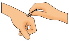 Punture di insetti. Rimozione del pungiglione. Punture di insetti. L’eventuale pungiglione va tolto.