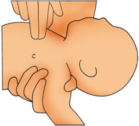 Primo soccorso per i bambini. Massaggio cardiaco. Primo soccorso per neonati e bambini. Per effettuare il massaggio cardiaco al bambino devono essere usate due dita.