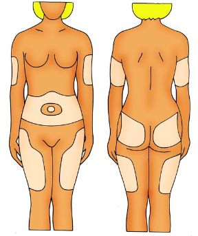 Sedi di iniezione sottocutanea. L'iniezione. Sedi di iniezione sottocutanea.