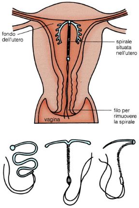 Metodi contraccettivi: la spirale. Spirale. I presidi tecnologici o farmacologici per la contraccezione agiscono impedendo il contatto tra spermatozoi e ovulo oppure modificando le caratteristiche del muco cervicale, bloccando l’ovulazione, alterando la mobilità delle tube, interferendo con l’annidamento nell’utero dell’ovulo: i più utilizzati sono il preservativo, la pillola, la spirale (in figura), il diaframma, gli spermicidi.