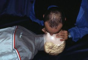 Arresto respiratorio. Insufflazione di aria. Arresto respiratorio. Se il soggetto è privo di sensi e non respira va posto in posizione supina e va effettuata la respirazione artificiale.