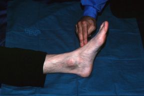 Rilevazione del polso pedidio. Rilevazione del polso pedidio. In caso di frattura agli arti inferiori, valutate la circolazione e la sensibilità distalmente al sito della lesione e ricercate il polso pedidio (arteria pedidia).