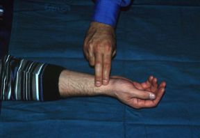 Rilevazione del polso radiale. Rilevazione del polso radiale. In caso di frattura agli arti superiori è indispensabile controllare il polso distale sia prima che dopo l'immobilizzazione.
